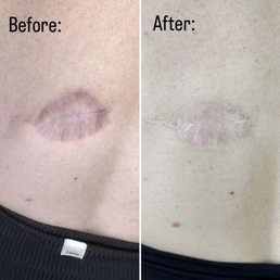 Scar before and after Scar Camouflage Tattoo sessions. Scar before and after Scar Camouflage Tattoo sessions.