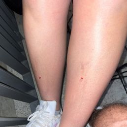 Legs cut by glass. Legs cut by glass.