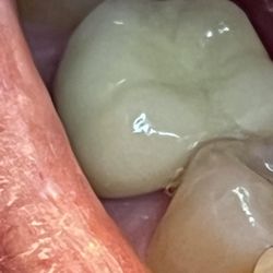 Sun City Dentistry - Bad crown Sun City Dentistry! Too large. Doesn't fit. Ugly. PAIN! Space between molars w/ food compacting. PAIN!