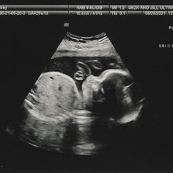 Jack and Jill Fetal Photos - Baby girl - cord in her face!