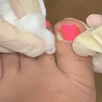 Best Nail - INFECTED - Nail Salons Near Me - Muncie, Indiana Best Nail - INFECTED - Nail Salons Near Me - Muncie, Indiana
