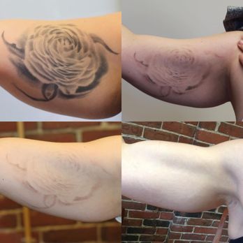 Removery Tattoo Removal & Fading - Tattoo Removal Near Me - Surrey, British Columbia Removery Tattoo Removal & Fading - Tattoo Removal Near Me - Surrey, British Columbia