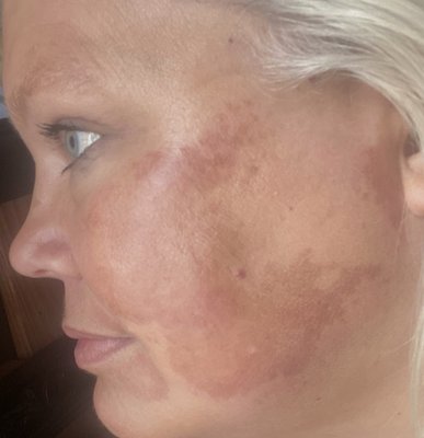 Micro-Needling Treatments - Micro-Needling for Anti-Aging and Acne Scarring!