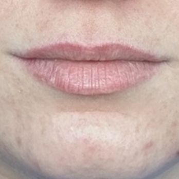 Injection Bar Medspa & Wellness - Before any lip filler - virgin lips - Medical Spas Near Me - Richmond, Texas Injection Bar Medspa & Wellness - Before any lip filler - virgin lips - Medical Spas Near Me - Richmond, Texas