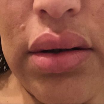 NU Image MedSpa - Horrible lip injections. And they "fixed them" twice! - Medical Spas Near Me - Paramus, New Jersey