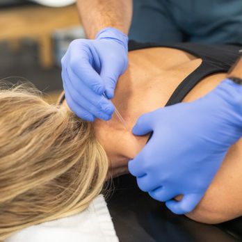 Fortify Physical Therapy - Dry Needling - Physical Therapy Near Me - St George, Utah