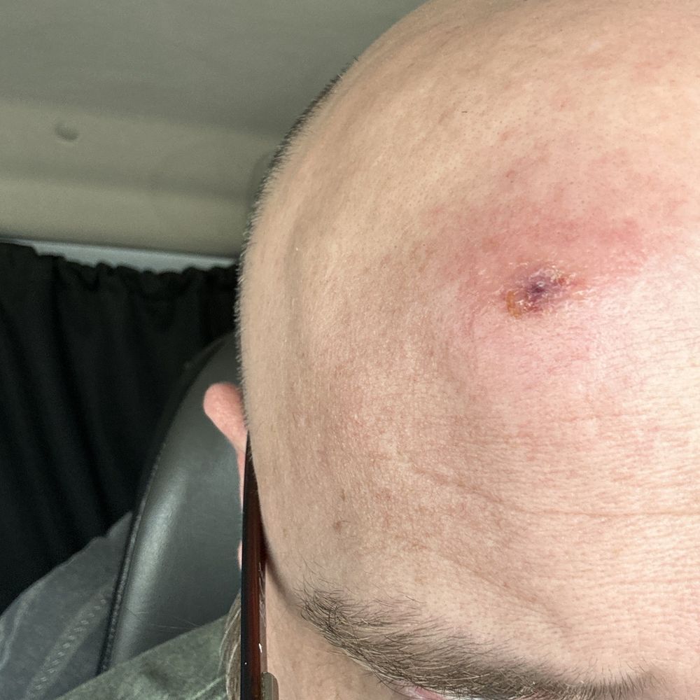 Quality Inn Tysons Corner - Another bite and this is my forehead. Looks like I was assaulted. - Hotels Near Me - Vienna, Virginia Quality Inn Tysons Corner - Another bite and this is my forehead. Looks like I was assaulted. - Hotels Near Me - Vienna, Virginia