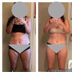 Ellsworth Plastic Surgery - Before and after two rounds of plastics with Dr. Ellsworth after 80lb weightloss