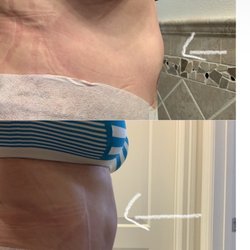 Plastic Surgery Institute of California - Top photo shows approximately 6 weeks post tummy tuck. Bottom phot shows at around one year post op.