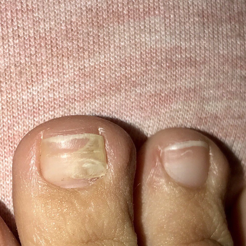Thanks for the fungus Holly nails!