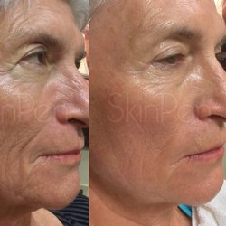 Bowtique Med Spa - SkinPen FDA cleared microneedling