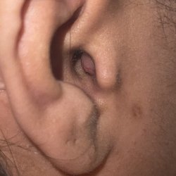 Campbell Ear Nose & Throat - See the drainage?