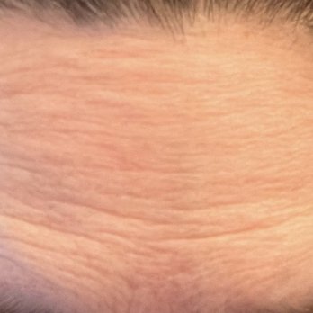 SkinSculpt MedSpa + BodyShaping - Forehead - Medical Spas Near Me - South Ogden, Utah SkinSculpt MedSpa + BodyShaping - Forehead - Medical Spas Near Me - South Ogden, Utah