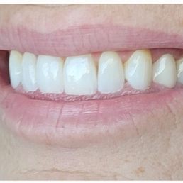 Perfection! I can't tell which tooth is crown! Perfection! I can't tell which tooth is crown!
