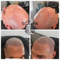 Scalp Aesthetics Dearborn - Stay tuned for the last session, scalp micro pigmentation , before and after