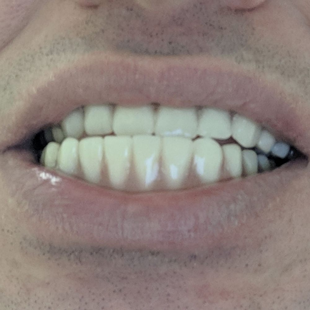 Aspen Dental - Mattoon, IL - Poor alignment of dentures due to negligence or malpractice - Oral Surgeons Near Me - Mattoon, Illinois