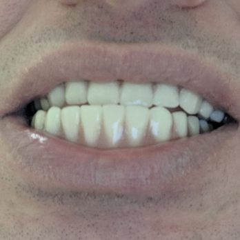 Aspen Dental - Mattoon, IL - Poor alignment of dentures due to negligence or malpractice - Oral Surgeons Near Me - Mattoon, Illinois