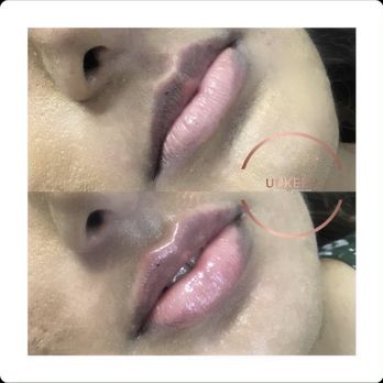 UPKEEP - Lip fillers before and after. - Medical Spas Near Me - New York, New York UPKEEP - Lip fillers before and after. - Medical Spas Near Me - New York, New York