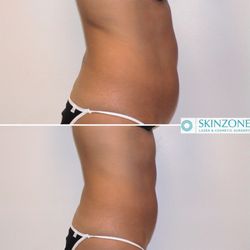 Skinzone Medical: Hannah Vu, MD - Side view of a full abdomen liposculpture.