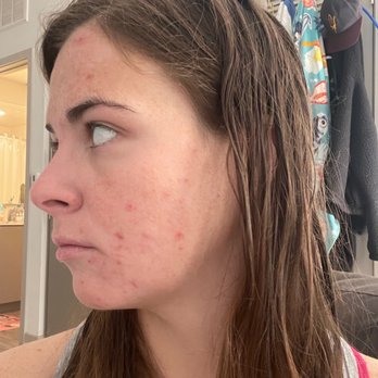 Skin Laundry - Biltmore - Before - Skin Care Near Me - Phoenix, Arizona