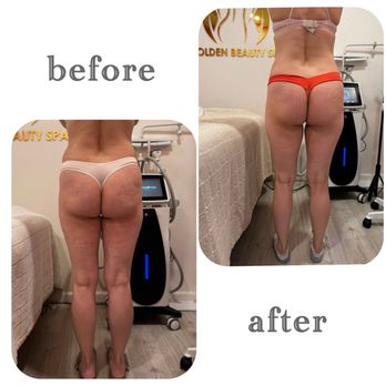 Yakobs Beauty - Before/after - Body Contouring Near Me - Sunnyvale, California Yakobs Beauty - Before/after - Body Contouring Near Me - Sunnyvale, California