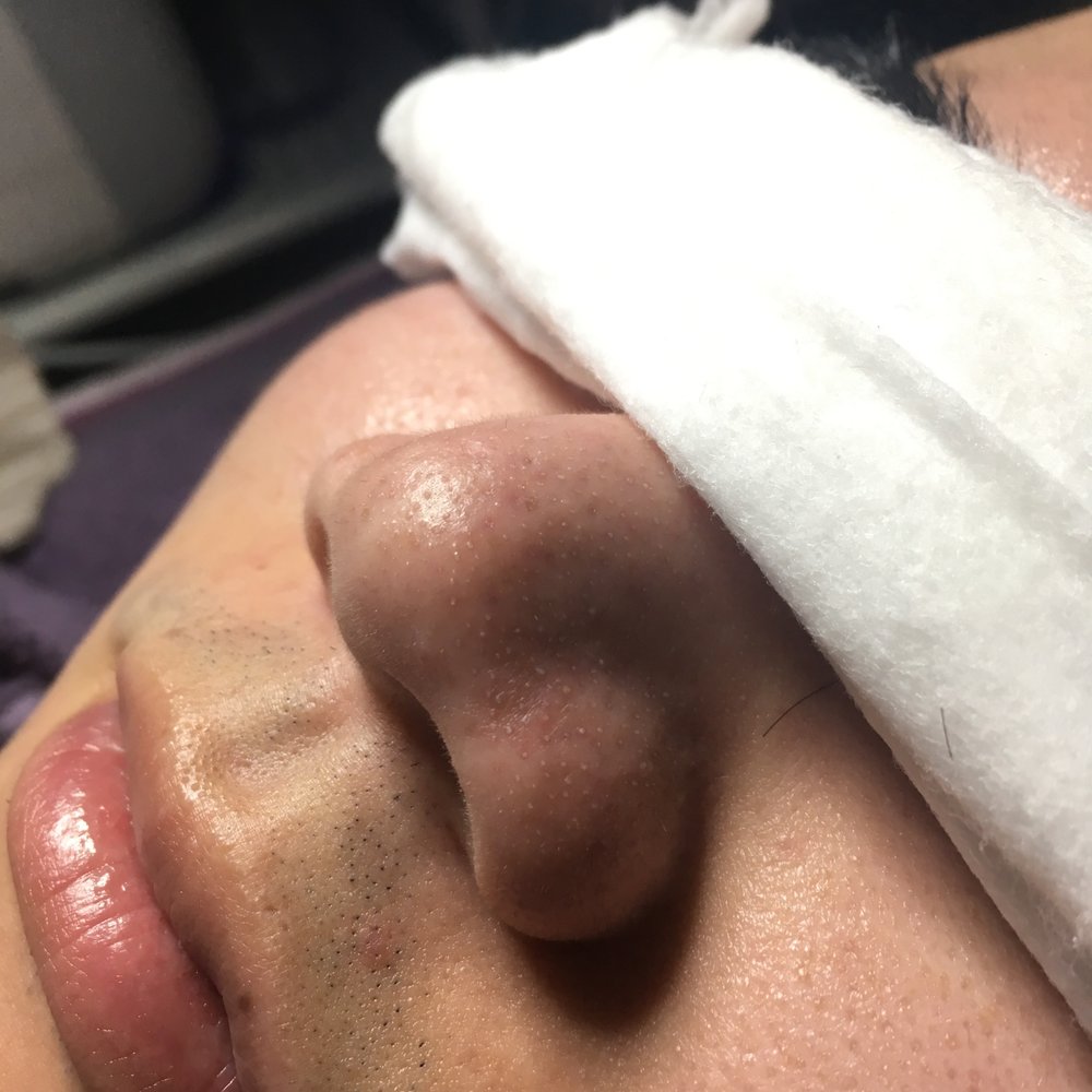 Before my friend's deep cleaning treatment (you can see all the blackhead pop out after some treatment)
