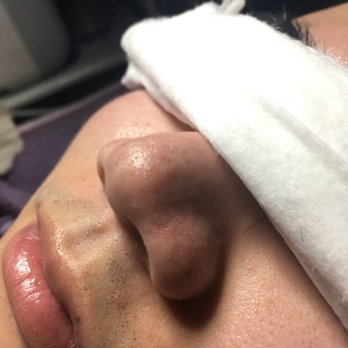 New Life Spa - Before my friend's deep cleaning treatment (you can see all the blackhead pop out after some treatment) - Skin Care Near Me - Newark, California New Life Spa - Before my friend's deep cleaning treatment (you can see all the blackhead pop out after some treatment) - Skin Care Near Me - Newark, California