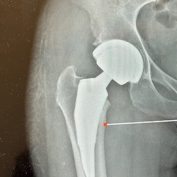 Han Orthopaedics - Hip replacement - Orthopedists Near Me - Los Angeles, California Han Orthopaedics - Hip replacement - Orthopedists Near Me - Los Angeles, California