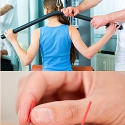 Advanced Physical Therapy & Spinal Rehab - Acupuncture physical therapy
