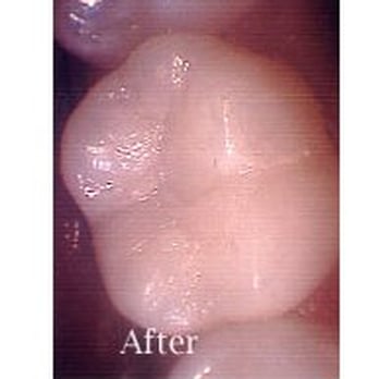 Irving J Leonard, DDS - Restoration of Decayed Tooth - Oral Surgeons Near Me - Chicago, Illinois
