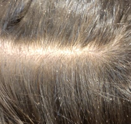 Head Lice, Louse, nymphs and nits removal - Lice nits, louse, nymphs removal from the comfort of your home. Head Lice, Louse, nymphs and nits removal - Lice nits, louse, nymphs removal from the comfort of your home.