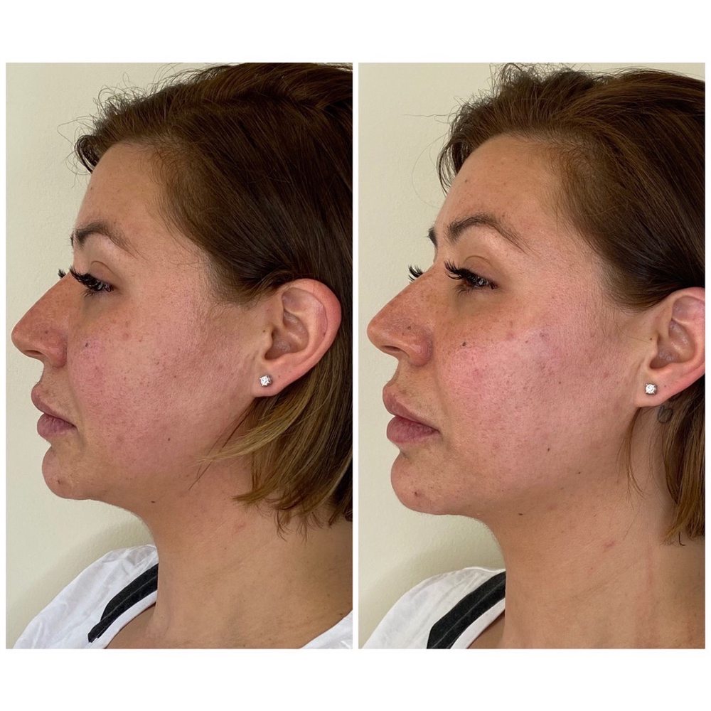SkinSplendid - Before and after my amazing silhouette thread lift! - Medical Spas Near Me - Montclair, New Jersey