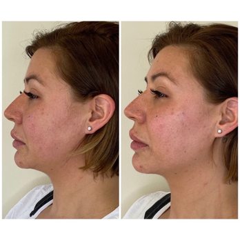 SkinSplendid - Before and after my amazing silhouette thread lift! - Medical Spas Near Me - Montclair, New Jersey