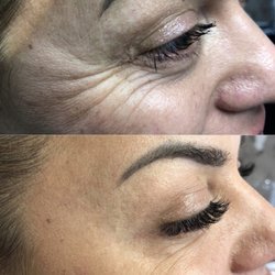 A Beautiful Look Medical Spa - Xeomin...Neuromodulators for wrinkle prevention.