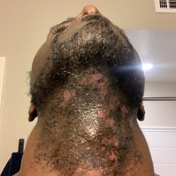 Las Vegas Dermatology - Day-3 After Procedure - Dermatologists Near Me - Las Vegas, Nevada