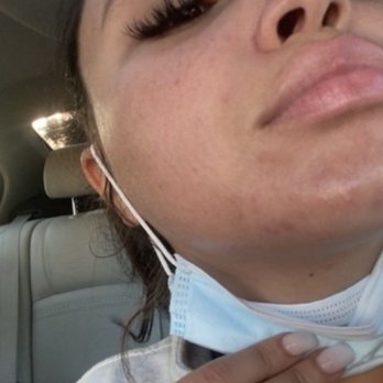 RD Skin Solutions - Before my chemical peel, acne and inflammation - Skin Care Near Me - Houston, Texas