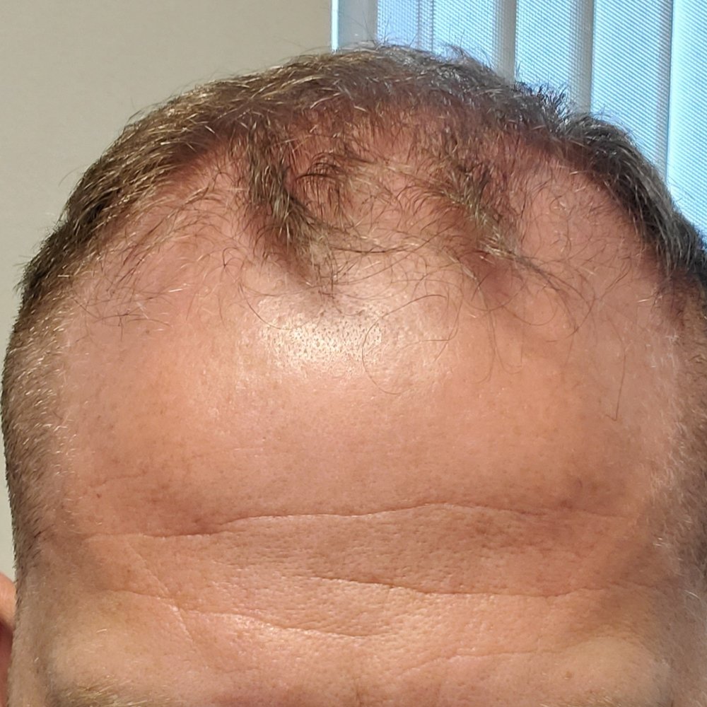 SMP INK - Before - Hair Loss Centers Near Me - Las Vegas, Nevada SMP INK - Before - Hair Loss Centers Near Me - Las Vegas, Nevada