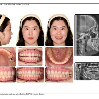 Vivian Lee Orthodontics - After photos (11/2024) Top front four teeth were bonded & 4 back crowns (general dentist) - Orthodontists Near Me - Arcadia, California Vivian Lee Orthodontics - After photos (11/2024) Top front four teeth were bonded & 4 back crowns (general dentist) - Orthodontists Near Me - Arcadia, California