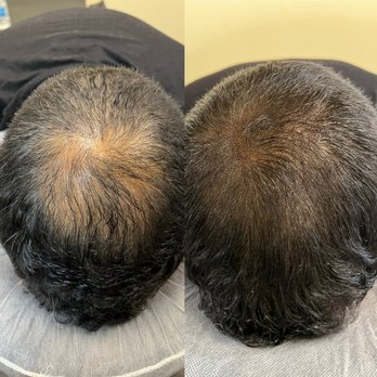 303 SMP Clinic - Density treatment - Hair Loss Centers Near Me - Broomfield, Colorado 303 SMP Clinic - Density treatment - Hair Loss Centers Near Me - Broomfield, Colorado