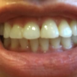 Westview Dental Center and Fastbraces - A little better picture where you can see braces with this dentist are just a waste of money. My teeth still look crooked