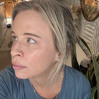 SDBotox - Carlsbad - Botox side eye - Skin Care Near Me - Carlsbad, California SDBotox - Carlsbad - Botox side eye - Skin Care Near Me - Carlsbad, California