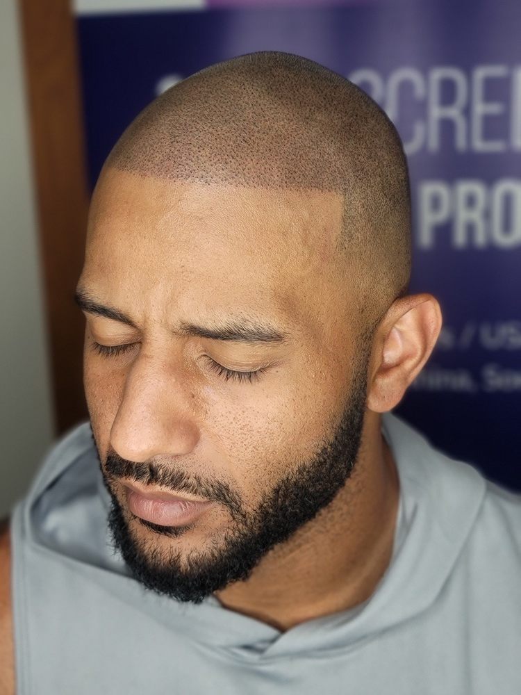 SCALP ARTIST INTERNATIONAL — hair transplant clinic in Denver
