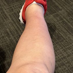 Acupuncture and Herbal Medicine - Formerly swollen ankle after several weeks of acupuncture.