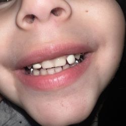 Children's Choice Dental Care - Vallejo - They fused her two front teeth together when putting fillings & Very poorly placed crown on right
