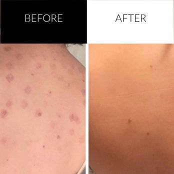 Visage Medispa - IPL Sun spot removal. - Medical Spas Near Me - East Setauket, New York Visage Medispa - IPL Sun spot removal. - Medical Spas Near Me - East Setauket, New York