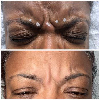 Michael Lin, MD - 48 hour results - Dermatologists Near Me - Sherman Oaks, California Michael Lin, MD - 48 hour results - Dermatologists Near Me - Sherman Oaks, California