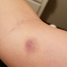 There's more bruising all over my body but it's too light to show on pictures. There's more bruising all over my body but it's too light to show on pictures.