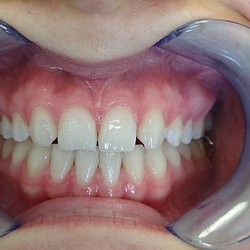 Lasting Impression Dental Lab - Before