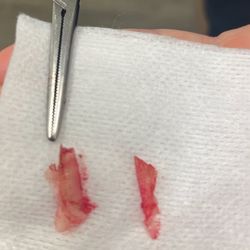Texas Foot & Ankle Specialists - Inground after removal