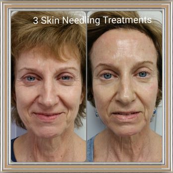 Glo-More Cosmetics & Spa - Skin Needling: helps to minimize fine lines and wrinkles - Waxing Near Me - Gurnee, Illinois Glo-More Cosmetics & Spa - Skin Needling: helps to minimize fine lines and wrinkles - Waxing Near Me - Gurnee, Illinois